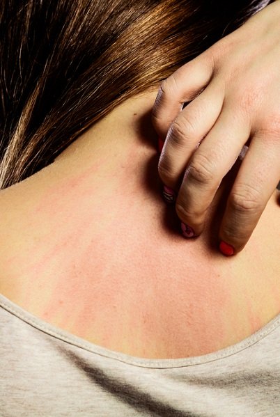 Problème peau allergies grattage et naturopathie